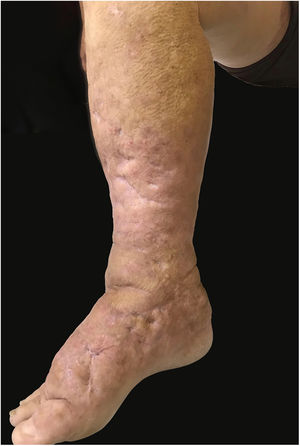 Aspect of lesions after five months of treatment with adalimumab.