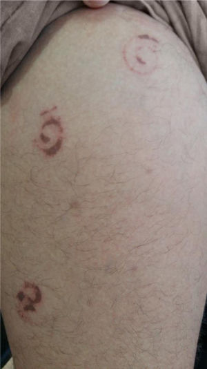 Spiral-shaped erythematous-brown spot on the right thigh.