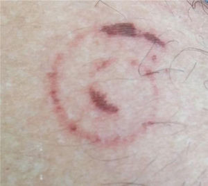 Detail of the lesion.