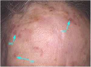 Non-pigmented facial actinic keratoses: multiple small papules and erythematous plaques with whitish scales on the surface and varying degrees of hyperkeratosis.
