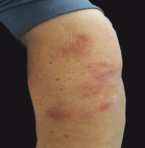 Multiple, painful, non-itching, purplish cutaneous plaques located on the left arm.