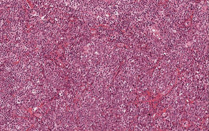 Clusters of oval-shaped cells with abundant cytoplasm, eccentric nuclei, and “clock face” chromatin (Hematoxylin & eosin, x200).