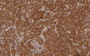 Monoclonal expression of immunoglobulin kappa light chains (Immunoperoxidase, x200).