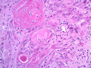 Blocks of atypical epithelial cells with corneal pearl formation (Hematoxylin & eosin, ×200).
