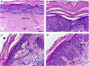 Skin, abdominal region, panoramic view: (A) hyperkeratosis, psoriasiform acanthosis, and moderate superficial perivascular lymphoid infiltrate; (B) detail of the previous image – there is altered hyperparakeratosis; (C) area of acantholytic dyskeratosis and supra-basal intraepidermal cleft; (D) marked congestion (arrow) with transepidermal elimination of red blood cells. Hematoxylin & eosin, original magnification of 100× (A) and 400× (B–D).