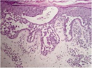 Extensive suprabasal acantholysis with intraepidermal bullae and keratinocytes with “dilapidated brick wall” appearance (Hematoxylin & eosin, ×40).