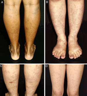 Clinical presentation of macular lymphocytic arteritis over the lower extremities. (A) Multiple linear and sometimes whirled hyperchromic macules, varicose veins, and a biopsy scar in the right calf; (B) rounded and ill-defined macules scattered over the limbs; (C) ill-defined hyperchromic macules, with some lesions being slightly infiltrated on palpation, and a biopsy scar in the left calf; (D) erythematous macules in a reticulated pattern associated with livedo racemosa.