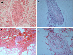 Histological biopsy examination of lesions compatible with lymphocytic macular arteritis in the legs. (A) A small cutaneous artery in the deep dermis is surrounded and infiltrated by lymphocytes (Hematoxylin & eosin, x200); (B) narrowing of the vessel lumen by subintimal thickening (Hematoxylin & eosin, x100); (C) dense inflammation is present around and involving the walls of an arteriole in the superficial subcutaneous layer (Hematoxylin & eosin, x200); (D) hypodermal vessel with organized thrombus (Hematoxylin & eosin, x200).