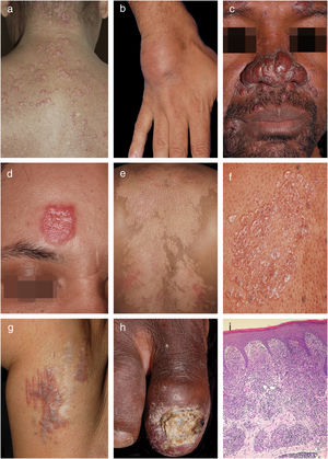 Cutaneous sarcoidosis: clinico–epidemiological profile of 72 patients ...