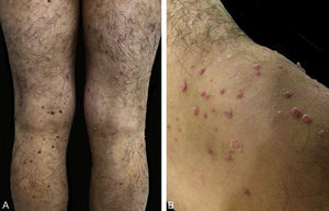 (A and B) Pink and skin-colored papules, with a warty appearance and a sessile base.