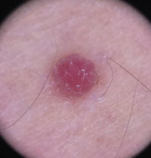 Dermoscopy: homogeneous pink vascular lesion, with small scales on the surface.