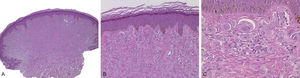 (A and B) A symmetrical and well-circumscribed compound melanocytic proliferation, arranged in epitheloid cell nests (A. Hematoxylin & eosin, ×40, B. Hematoxylin & eosin, ×100). (C) Epithelioid melanocytes with abundant eosinophilic cytoplasm, vesicular nucleus, and nucleolus (C. Hematoxylin & eosin, ×400).