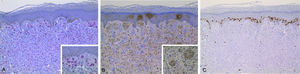 Immunohistochemical study. (A) SOX10 with a nuclear staining pattern in melanocytes. (B) S100 protein was positive. (C) S100 protein was positive.