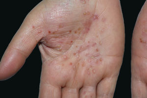 Pustules located on normal and erythematous skin of palms with brown discoloration.