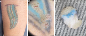 (A) Clinical aspect of the tattoo with multiple papules arranged linearly. (B) In vivo dermoscopy (×10 magnification) showing papules with digitiform and red dotted projections corresponding to vascular ectasias. (C) Ex vivo dermoscopy (×20 magnification) showing papillomatous and dotted hemorrhagic projections in the epidermis, with presence of pigment in the superficial dermis.