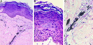 Histopathological exam of Patient 2, stained with hematoxylin & eosin. In (A) (×200 magnification) hyperkeratotic epidermis with the presence of balonized keratinocytes on the epidermal surface is observed. In the dermis, there are exogenous black pigment deposits around the vessels. In (B) (×400 magnification), nuclear polymorphism and hyperchromia are evident, in addition to the broad and basophilic cytoplasm of keratinocytes, characterizing the cytopathic effect of HPV. In (C) (×400 magnification), the black pigment of the tattoo deposited around the vessels is observed.