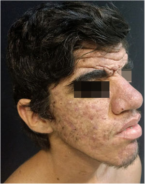 Erythematous papules and pustules on face, skin thickening, and accentuation of facial furrows with cutaneous gyrata (cutis verticis gyrata) on the forehead.