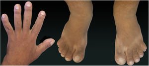 Fingers and toes showing volume increase and digital clubbing.