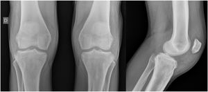 Benign hypertrophic periosteal reaction in metaphyses and epiphyses of the femur, tibia, and fibula bilaterally, with enlargement of the bones due to hyperostosis. Densification and increase of the thickness soft parts adjacent to the knee, especially in the anterior and lateral faces.