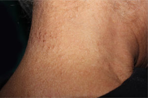 Multiple small whitish papules on the posterior cervical region.