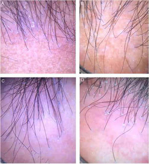 Tricoscopy of the frontal implantation region of patients a, b, e, f, showing absence of vellus and erythema and perifollicular desquamation in all cases, and interfollicular desquamation in C and D.