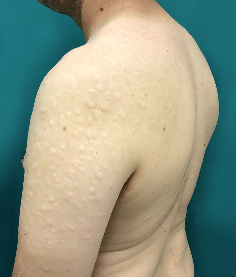 Aetoderma Anetoderma: an alert for antiphospholipid antibody syndrome | Anais ...