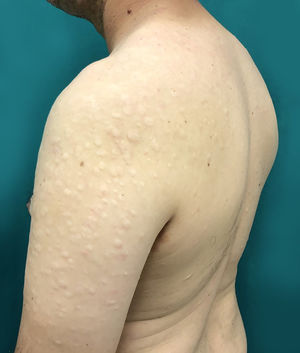 Multiple hypopigmented papules with central atrophy in the left arm.