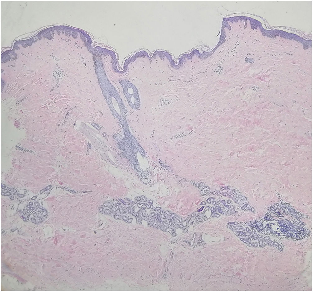A case of linear atrophoderma of Moulin | Anais Brasileiros de Dermatologia