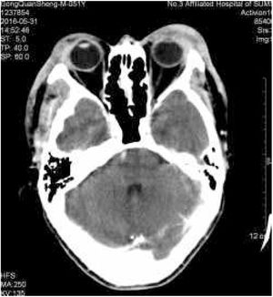 Soft-tissue lesions involving both the upper eyelid and parotid regions.
