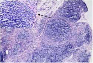 Nodular lymphocytic infiltrate with germinal centers involving the dermis and subcutaneous tissue, and reactive germinal centers surrounded by small mature lymphocytes and eosinophils (arrow) (Hematoxylin & eosin, ×100).