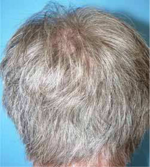 Repopulation of hair after one year of treatment with interferon alpha.