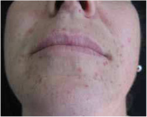 Multiple xanthogranulomas. Detail of yellowish-brown, smooth, firm papules with diameters of 1–3mm, asymptomatic, located on the face.