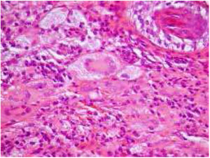Infiltration circumscribed of the dermis by xanthomized histiocytes and multinucleated Touton giant cells (Hematoxylin & eosin, ×400).