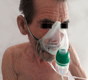Erythematous rash with fine desquamation onto the face on initial presentation.
