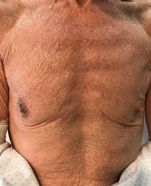 Erythematous rash with fine desquamation onto the trunk on initial presentation.