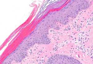 The biopsy showed a mild spongiotic and psoriasiform changes with discrete follicular hyperkeratosis (Hematoxylin & eosin x20).