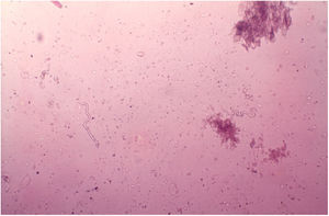 Onchocerciasis. Observe two microfilariae (Onchocerca volvulus). Direct examination in saline solution. 40× magnification (personal archive: Prof. Dr. Sinésio Talhari).