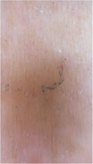 Sarcoptes scabiei. Dermoscopy. At the lower end, a “hang glider”-shaped dark spot, corresponding to the anterior segment of the mite.