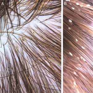 (A) Pediculus capitis on the scalp (Photo courtesy of Dr. Daniel França). (B) Nits, attached to the hair.