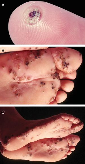 (A) Tungiasis – typical aspect. Isolated lesion. Note a pustule, in regression, with central crusted area. (B, C) Tungiasis. Multiple lesions, isolated and confluent.