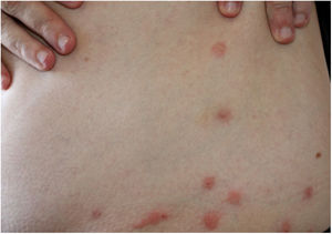 Bedbug dermatitis. Multiple, characteristic linear erythematous papular lesions located in the abdomen.