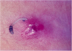 Furunculoid myiasis. Ulcero-nodular lesion and etiological agent (Dermatobia hominis).