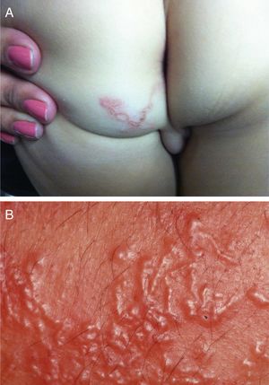 (A) Larva migrans. Intense pruritus. Typical serpiginous lesion with linear aspect. (B) Larva migrans. Numerous lesions caused by multiple larvae.