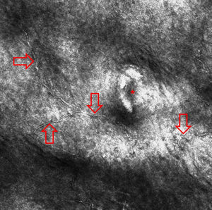 Reflectance confocal microscopy image of a case of tinea nigra reveals thin linear and hyper-reflective structures in upper part of the epidermis (red arrows; the asterisk indicates an acrosyringium).