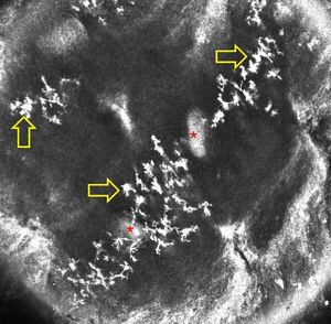 Reflectance confocal microscopy image of normal acral skin of a healthy person shows artifacts presenting as stellate hyper-reflective bodies in the epidermis (yellow arrows; asterisks indicate acrosyringia).