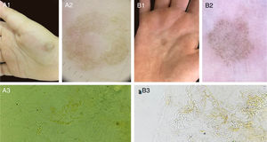 Two cases of tinea nigra with classic clinical presentation (A1, B1). Dermoscopy of both cases, with short hyperchromic linear structures in the epidermis (A2, B2). Direct mycological examination (KOH 20%), with short dematiaceous septate hyphae (A3 x200, B3 x400).