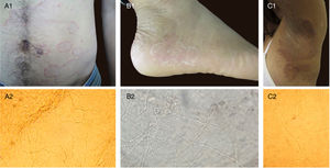 A1, B1, C1: clinical aspect of superficial mycoses. A2, B2, C2: direct mycological examinations (KOH 20%) corresponding to clinical presentations, presenting in all cases thin and long hyaline septated hyphae (x100, x400, x200, respectively).