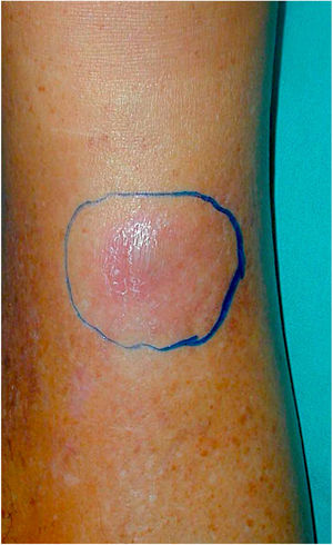 Erythematous nodule in the distal third of the right leg.