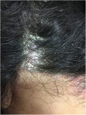 Erythematous scaly lesions on the scalp suggestive of psoriasis.