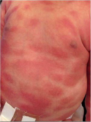 Erythematous plaques present at birth.